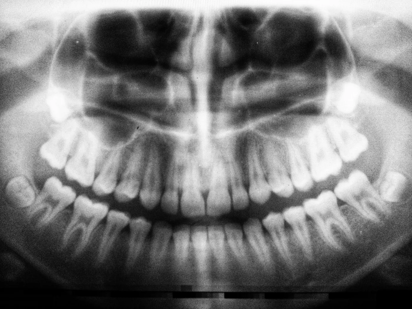 Radiografia panorâmica mostrando todos os dentes, incluindo os sisos